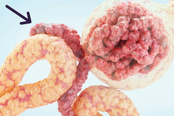 Blood vessel scarring in kidney Blood vessel scarring in kidney