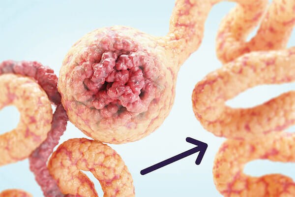 Thickening around tubules in kidney Thickening around tubules in kidney